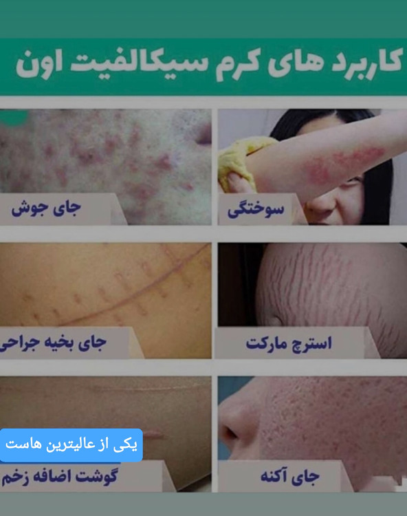 سفارش کرم ترمیم کننده سیکالفیت اون اورجینال و اصلی با ضمانت