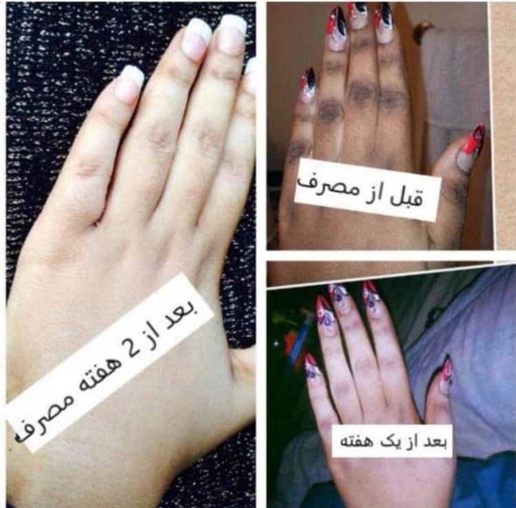 نتیجه استفاده از ست سفیدکننده قوی پوست صورت و بدن، قرص های سفیدکننده