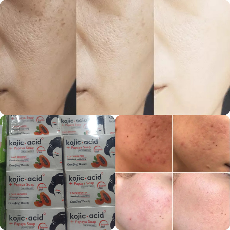 خرید و قیمت صابون سفیدکننده فوری و بسیار قوی کوجیک اسید ضدلک عالی و پرطرفدار اصلی